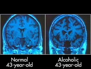 alcohol-brain.jpg